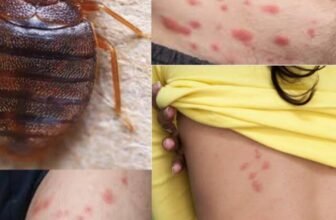 bed-bug-bites